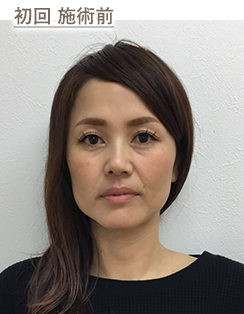 初回 施術前