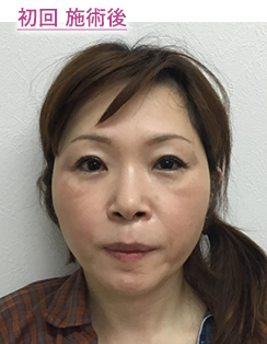 初回 施術後
