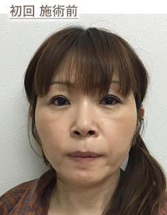 初回 施術前