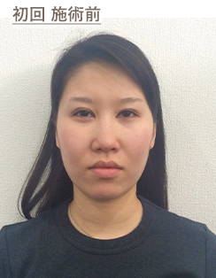 初回 施術前