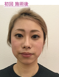 初回 施術後