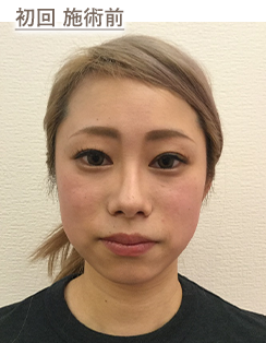 初回 施術前