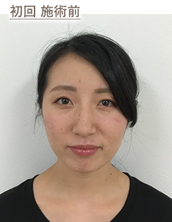 初回 施術前