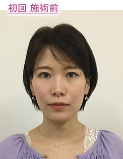 初回 施術後