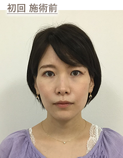 初回 施術前
