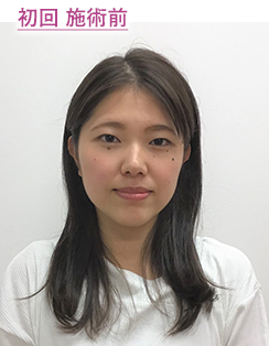 初回 施術後